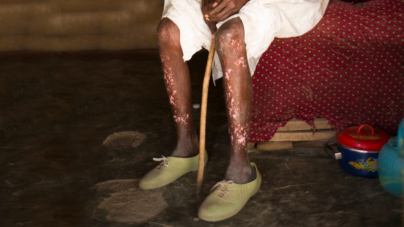 Simon's legs have clear scarring all over them.