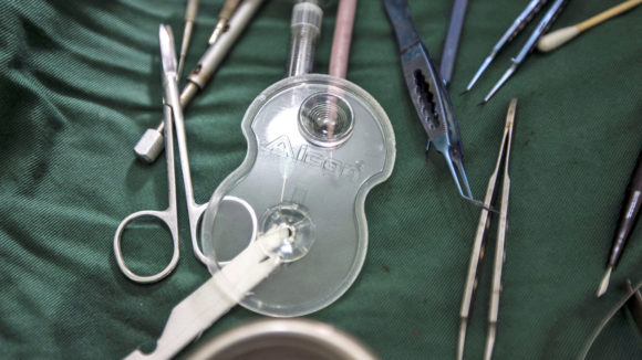 A collection of surgical instruments used for cataract operations, placed on green hospital fabric.