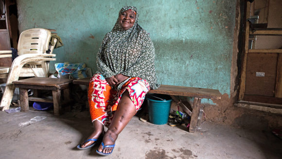 Hassana from Nigeria sits in her home. SHe has lymphatic filariasis and her left leg is visibly swollen.