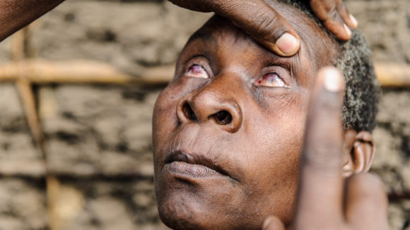 Aluna from Tanzania has her eyes checked for trachoma. They are visibly red and swollen.
