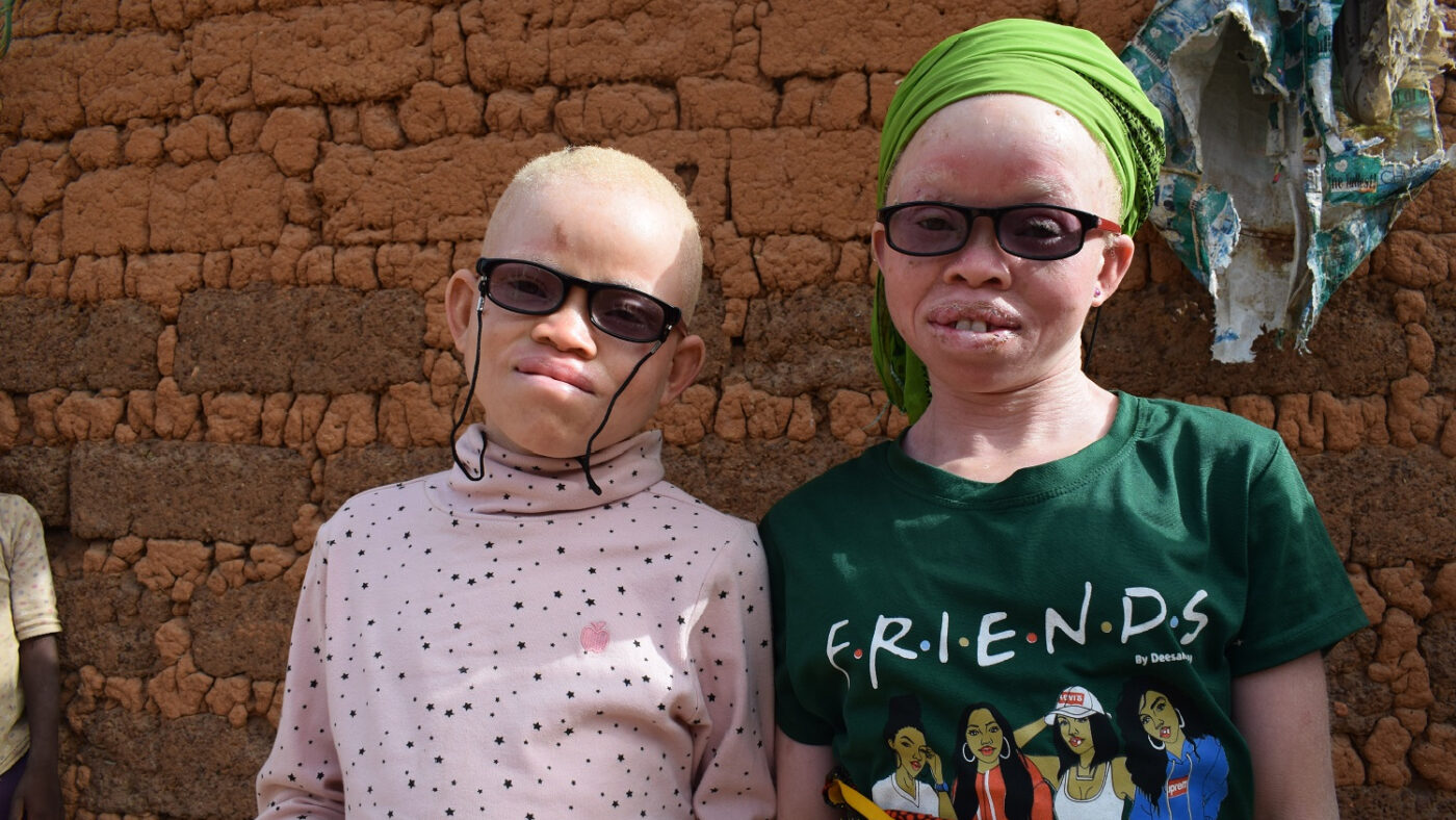 Two children with albinism wearing dark glasses stand outside in the sun.