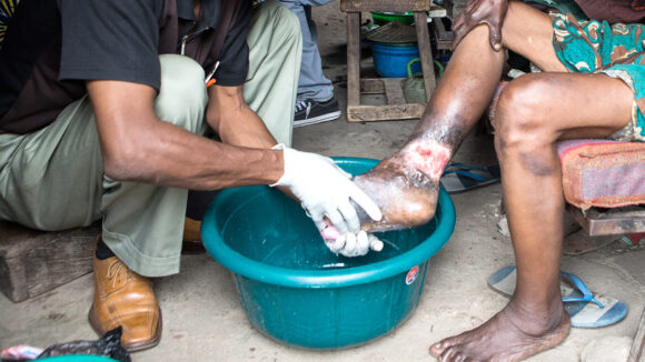 A close-up of a health worker helping a patient to wash their leg, which has a large sore on it. The health worker is wearing gloves.