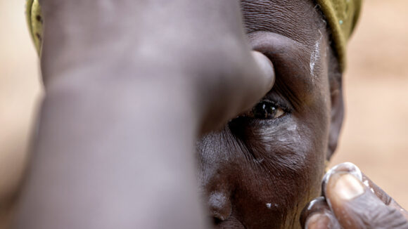 A close-up of a woman having her eyes checked for trachoma.