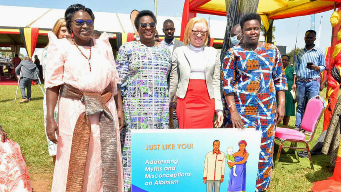 Four women, one of whom has albinism, stand around a banner about addressing myths about the condition.