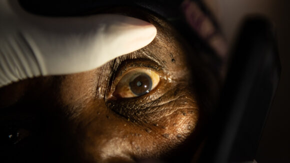A close-up of a patient's eye.
